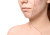 Let’s Face It: Answers to Your Acne Scar Questions